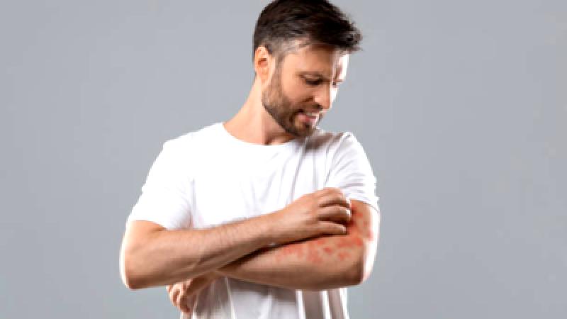 Tips for Managing Fungal Infections During the Monsoon