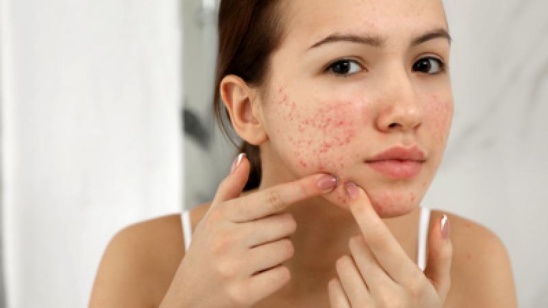 Dietary Guidelines to Follow When Dealing with Acne and Pimples