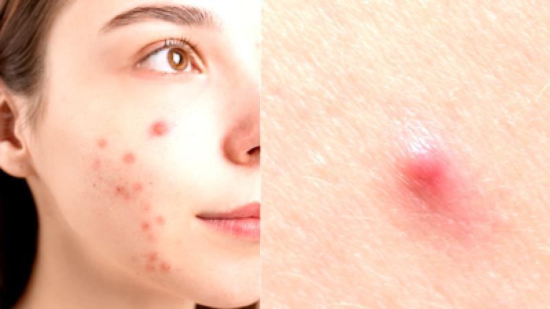 Distinguishing Between Pimples and Acne: Effective Healing Strategies
